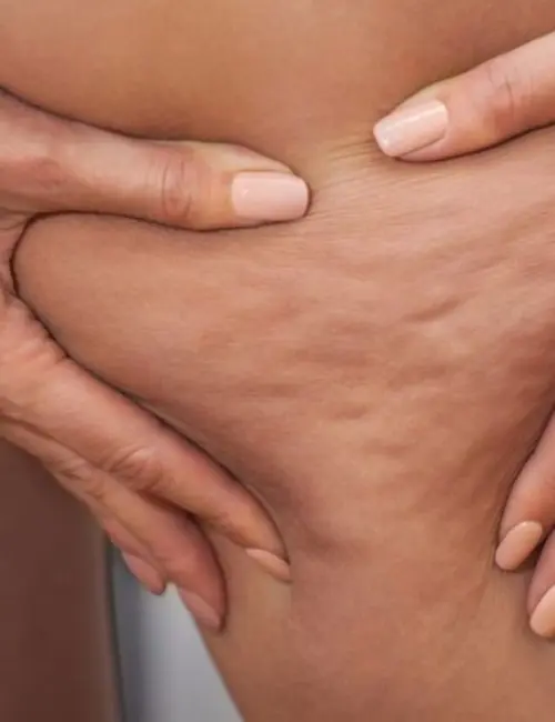 cellulite